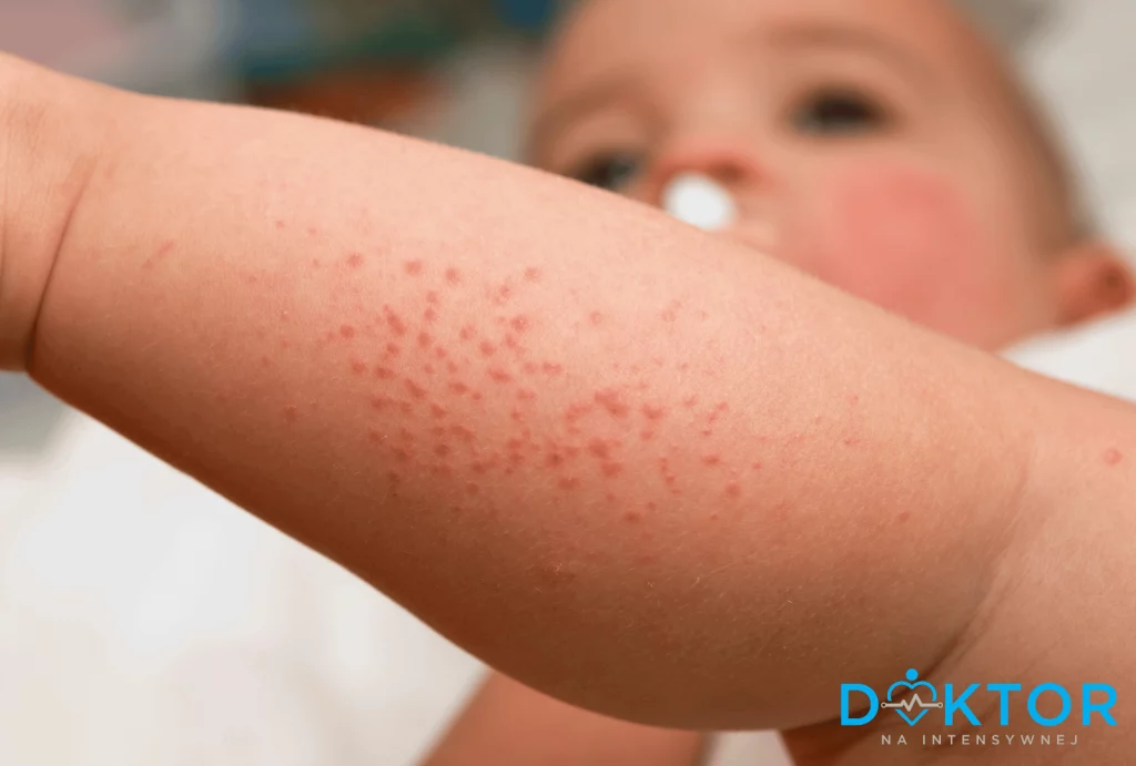 wysypka alergiczna u dziecka, doktor na intensywnej